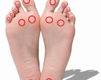 Diabetic Foot Common Areas for Ulcers