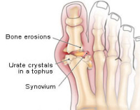 Gout Foot