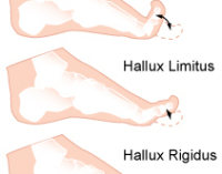 Halllux Rigidus