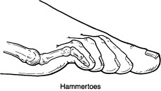 Hammertoes Hammertoes