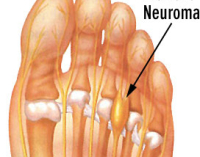 Morton's Neuroma