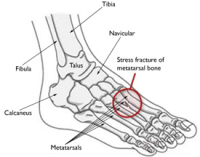 Stress Fracture on Foot