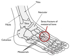 Toe and Metatarsal Fractures Toe and Metatarsal Fractures
