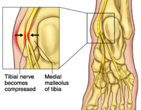 Tarsal Tunnel Syndrome