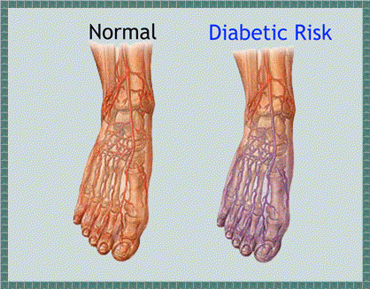 Diabetic Foot Problems Archives