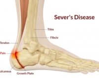 severs-disease