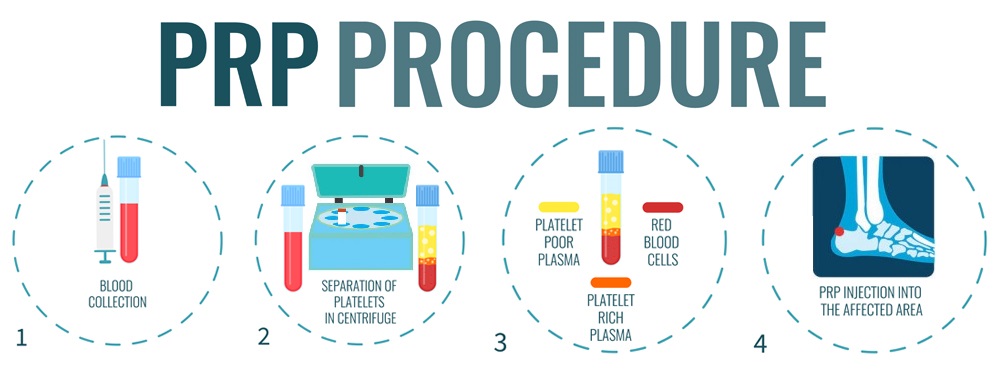 PRP Procedure steps