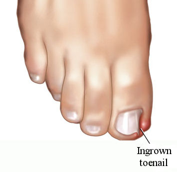 Ingrown Toenails | Barrett Podiatry